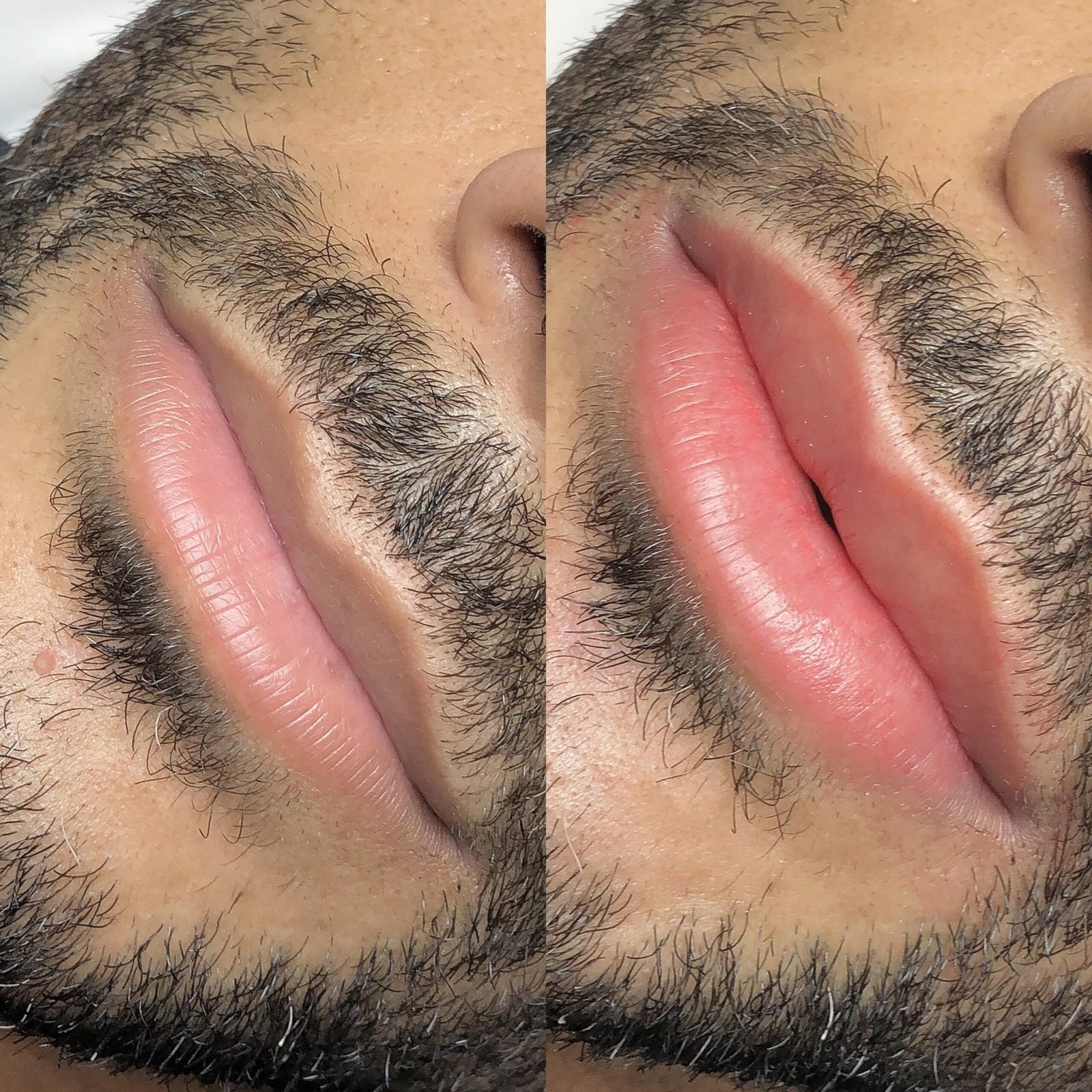 antes-e-depois-labios-3-scaled.jpg
