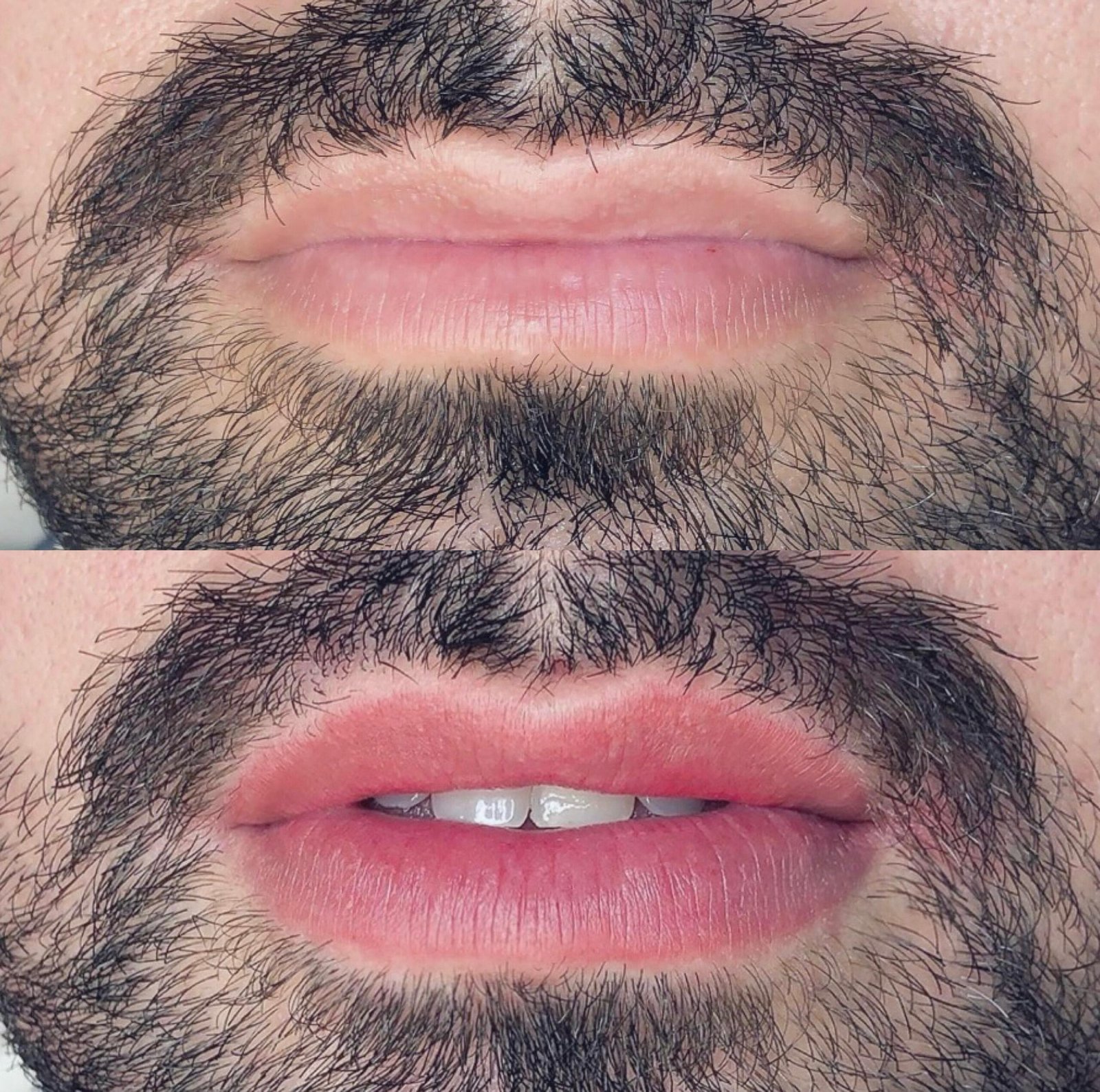 antes-e-depois-labios-4-scaled.jpg