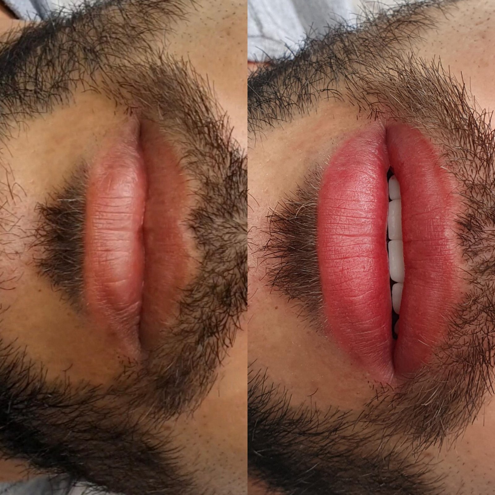 antes-e-depois-labios-5-scaled.jpg