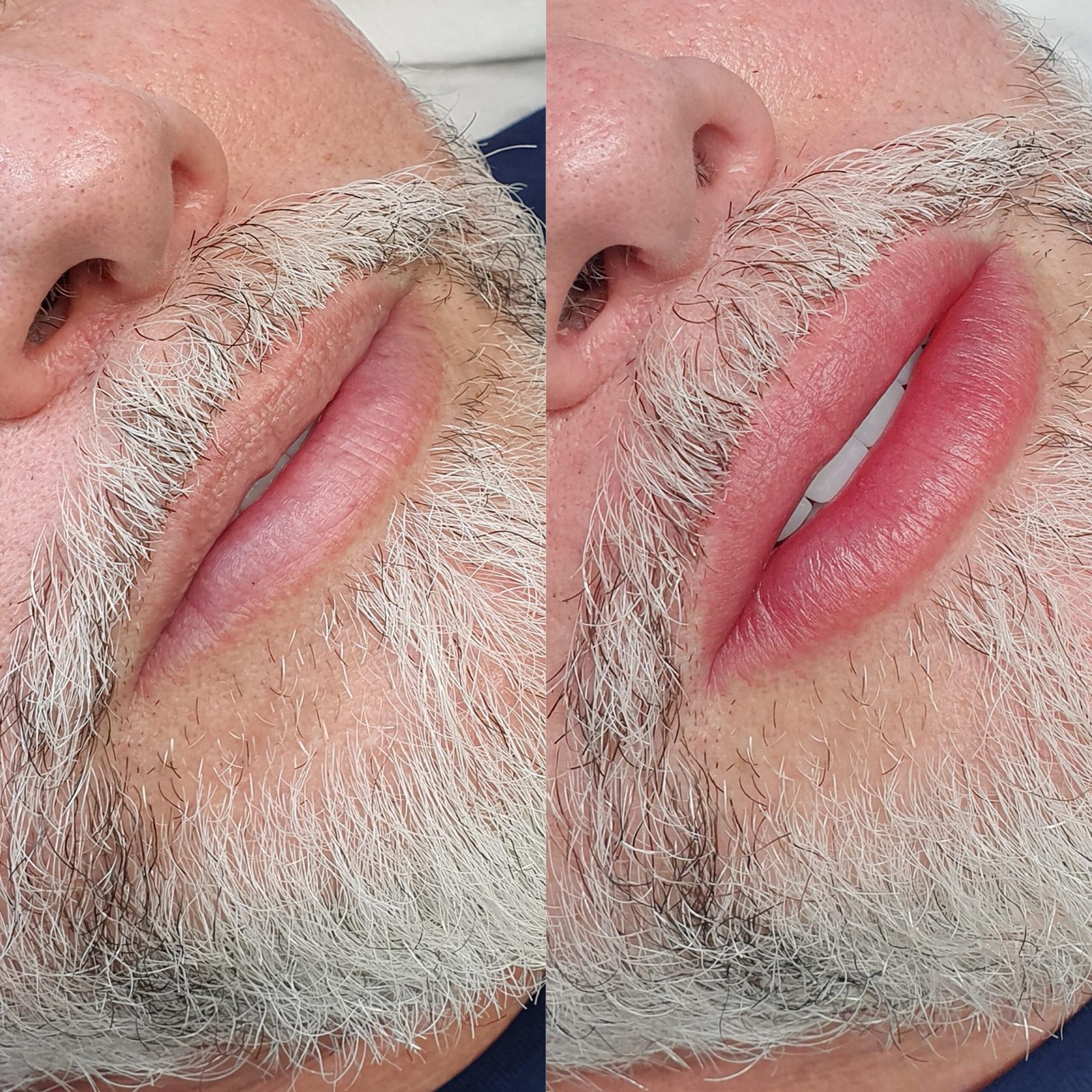 antes-e-depois-labios-6-scaled.jpg