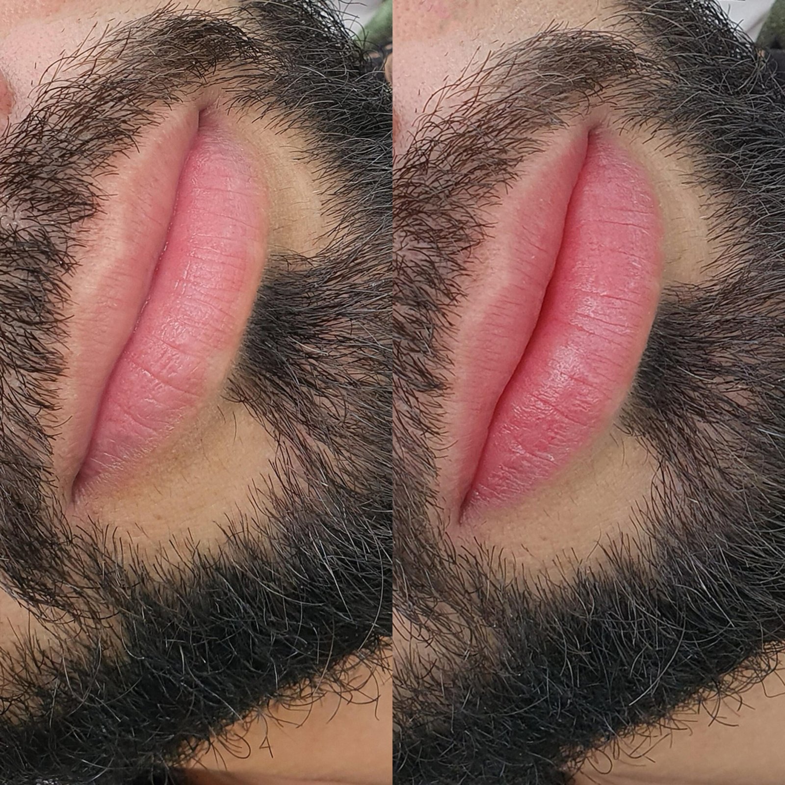 antes-e-depois-labios-7-scaled.jpg